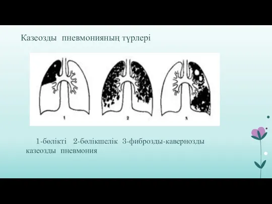 Казеозды пневмонияның түрлері 1-бөлікті 2-бөлікшелік 3-фиброзды-кавернозды казеозды пневмония
