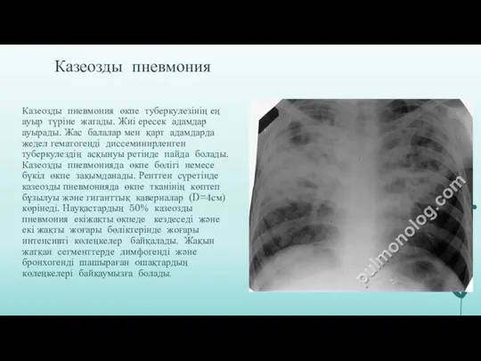 Казеозды пневмония Казеозды пневмония өкпе туберкулезінің ең ауыр түріне жатады.
