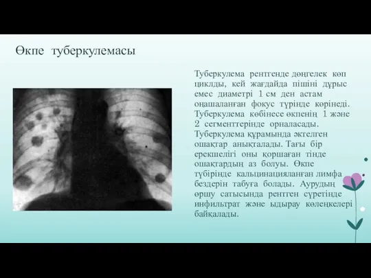 Өкпе туберкулемасы Туберкулема рентгенде дөңгелек көп циклды, кей жағдайда пішіні