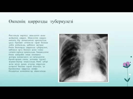 Өкпенің циррозды туберкулезі Рентгендік көрінісі: шектелген және жайылған цирроз. Шектелген