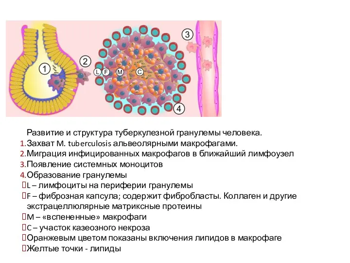 Развитие и структура туберкулезной гранулемы человека. Захват M. tuberculosis альвеолярными