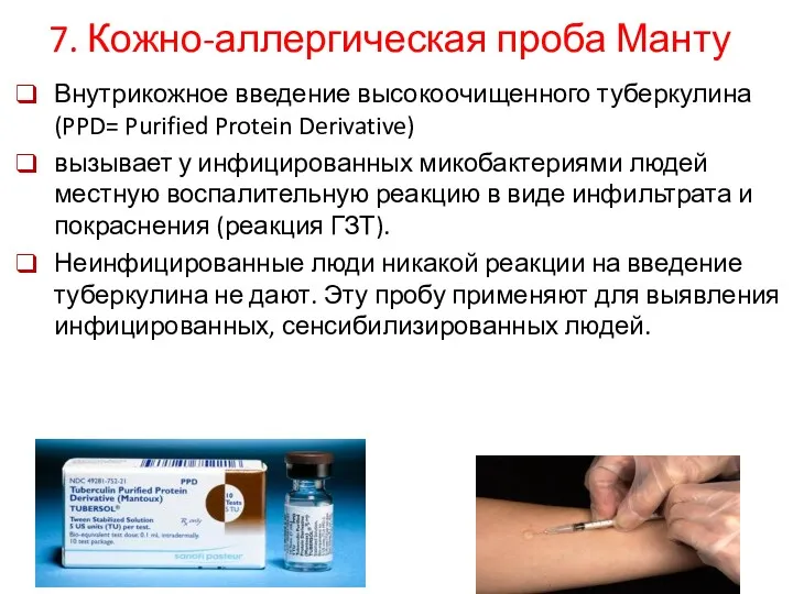 7. Кожно-аллергическая проба Манту Внутрикожное введение высокоочищенного туберкулина (PPD= Purified