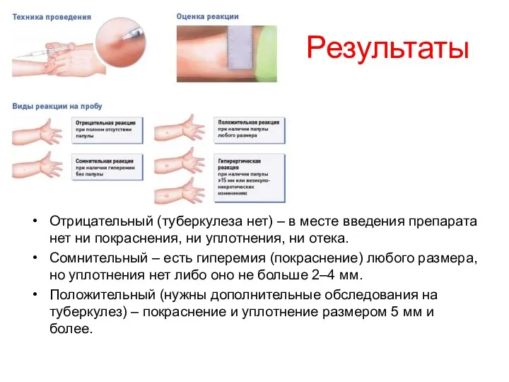 Результаты Отрицательный (туберкулеза нет) – в месте введения препарата нет