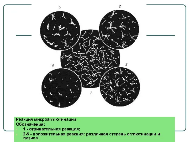 Реакция микроагглютинации Обозначения: 1 - отрицательная реакция; 2-5 - положительная реакция: различная степень агглютинации и лизиса.