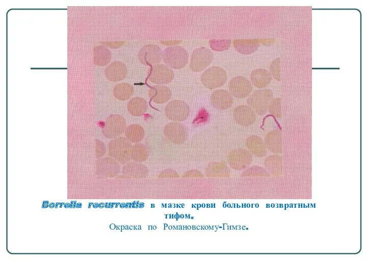 Borrelia recurrentis в мазке крови больного возвратным тифом. Окраска по Романовскому-Гимзе.