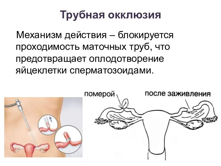 Трубная окклюзия Механизм действия – блокируется проходимость маточных труб, что предотвращает оплодотворение яйцеклетки сперматозоидами.