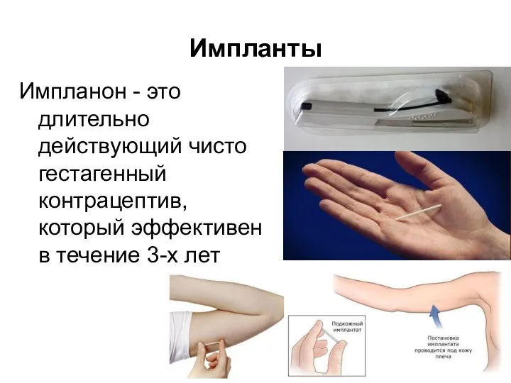 Импланты Импланон - это длительно действующий чисто гестагенный контрацептив, который эффективен в течение 3-х лет