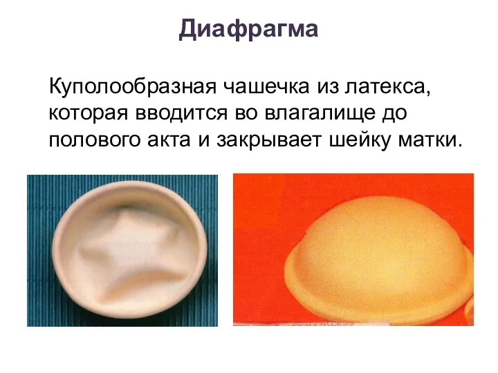 Диафрагма Куполообразная чашечка из латекса, которая вводится во влагалище до полового акта и закрывает шейку матки.
