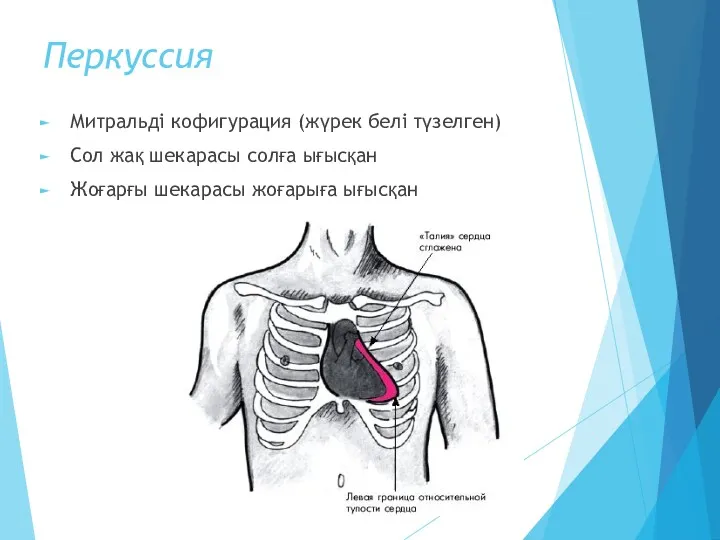 Перкуссия Митральді кофигурация (жүрек белі түзелген) Сол жақ шекарасы солға ығысқан Жоғарғы шекарасы жоғарыға ығысқан