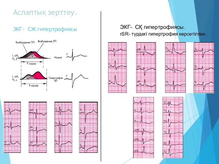 Аспаптық зерттеу. ЭКГ- СЖ гипертрофиясы ЭКГ- СҚ гипертрофиясы. rSR- түрдегі гипертрофия көрсетілген.