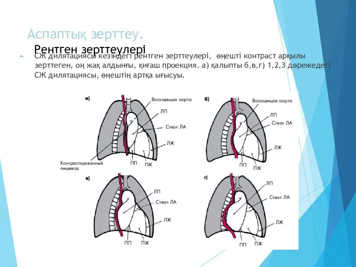 Аспаптық зерттеу. Рентген зерттеулері СЖ дилятациясы кезіндегі рентген зерттеулері, өңешті