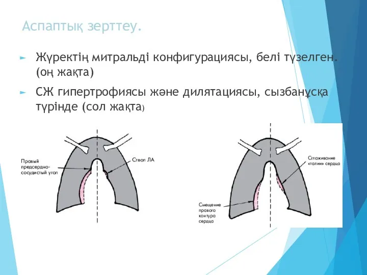 Аспаптық зерттеу. Жүректің митральді конфигурациясы, белі түзелген. (оң жақта) СЖ