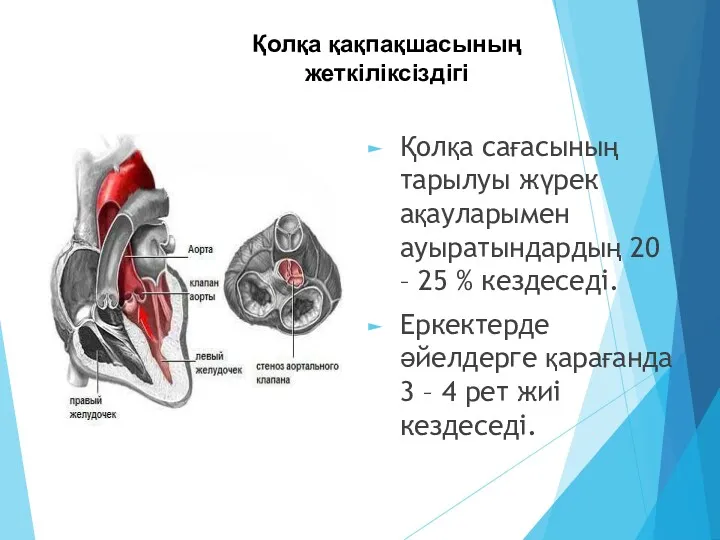 Қолқа сағасының тарылуы жүрек ақауларымен ауыратындардың 20 – 25 %