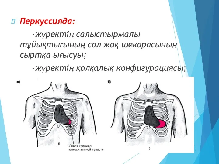 Перкуссияда: -жүректің салыстырмалы тұйықтығының сол жақ шекарасының сыртқа ығысуы; -жүректің қолқалық конфигурациясы; -тамыр шоғырының кеңеюі.