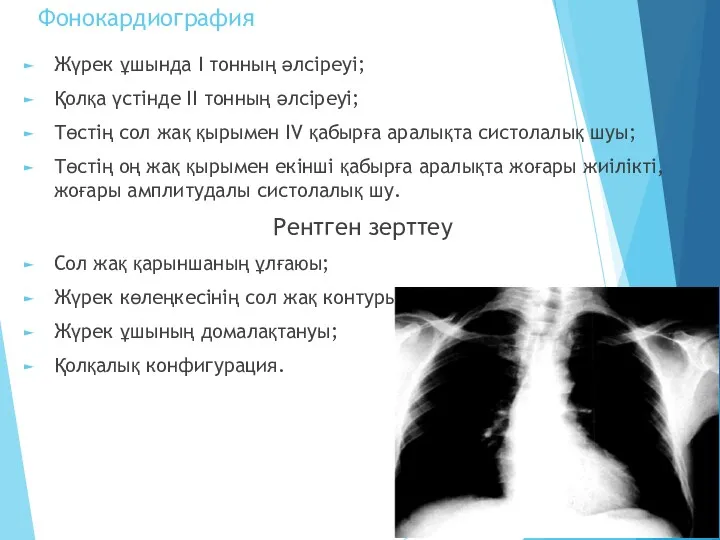 Фонокардиография Жүрек ұшында І тонның әлсіреуі; Қолқа үстінде ІІ тонның