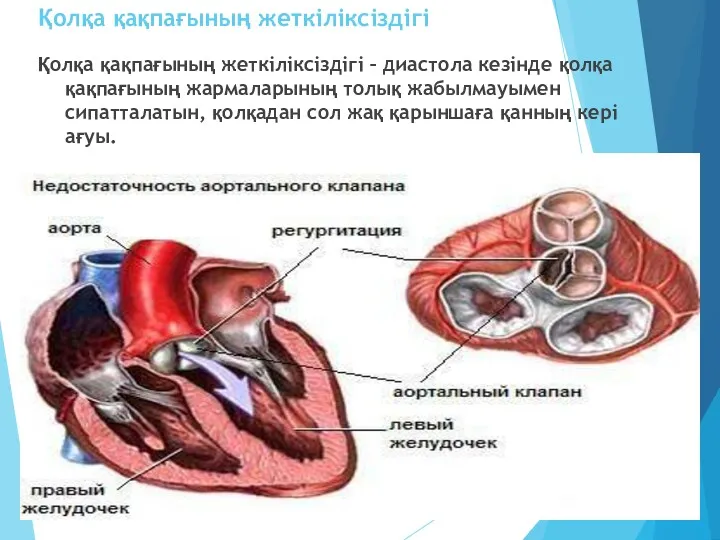 Қолқа қақпағының жеткіліксіздігі Қолқа қақпағының жеткіліксіздігі – диастола кезінде қолқа