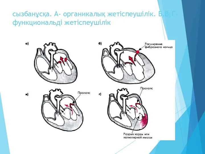 сызбанұсқа. А- органикалық жетіспеушілік. Б,В,Г- функциональді жетіспеушілік