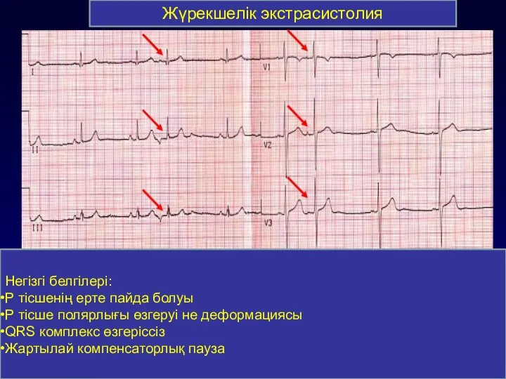 Жүрекшелік экстрасистолия Негізгі белгілері: Р тісшенің ерте пайда болуы Р