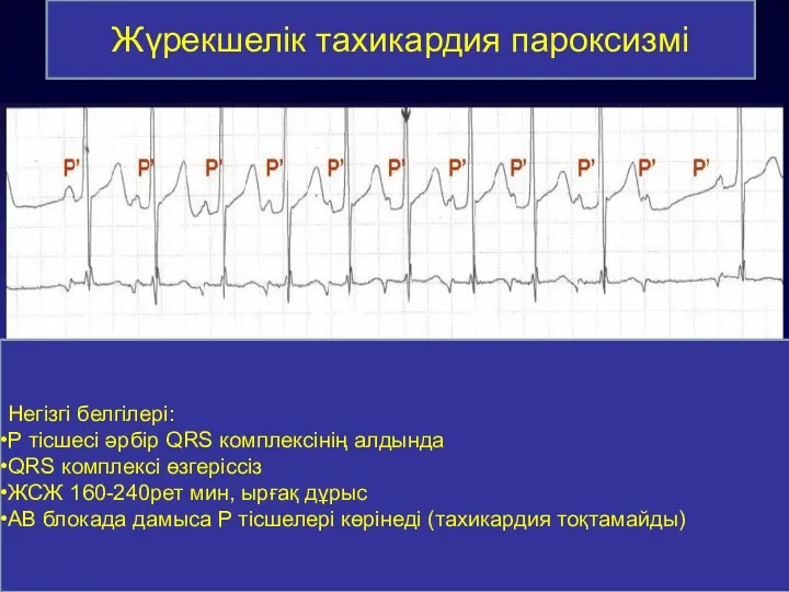 Жүрекшелік тахикардия пароксизмі Негізгі белгілері: Р тісшесі әрбір QRS комплексінің