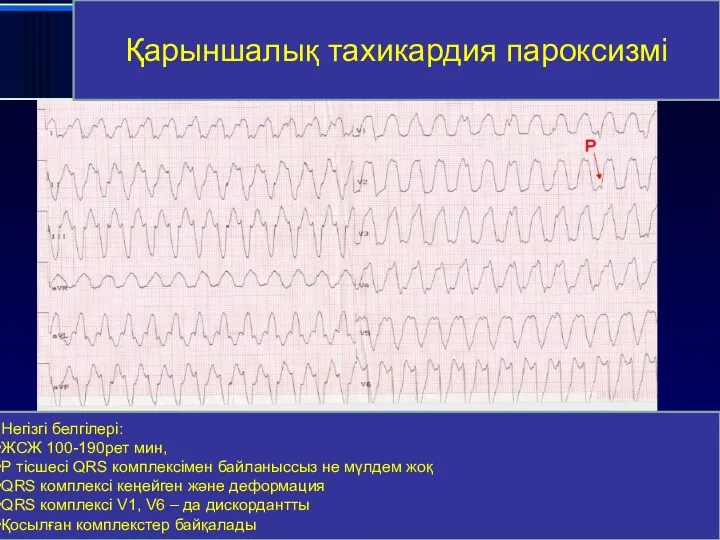 Пароксизмальная желудочковая тахикардия Қарыншалық тахикардия пароксизмі Негізгі белгілері: ЖСЖ 100-190рет