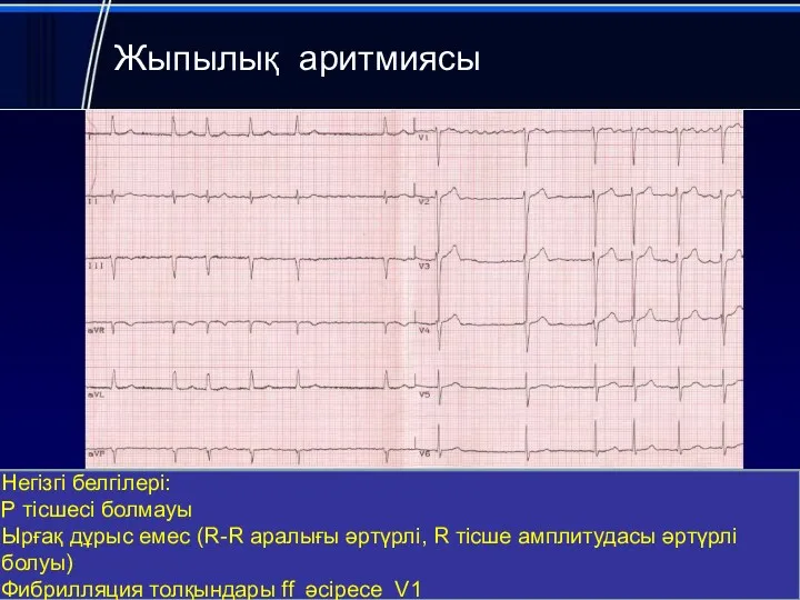 Жыпылық аритмиясы Негізгі белгілері: Р тісшесі болмауы Ырғақ дұрыс емес