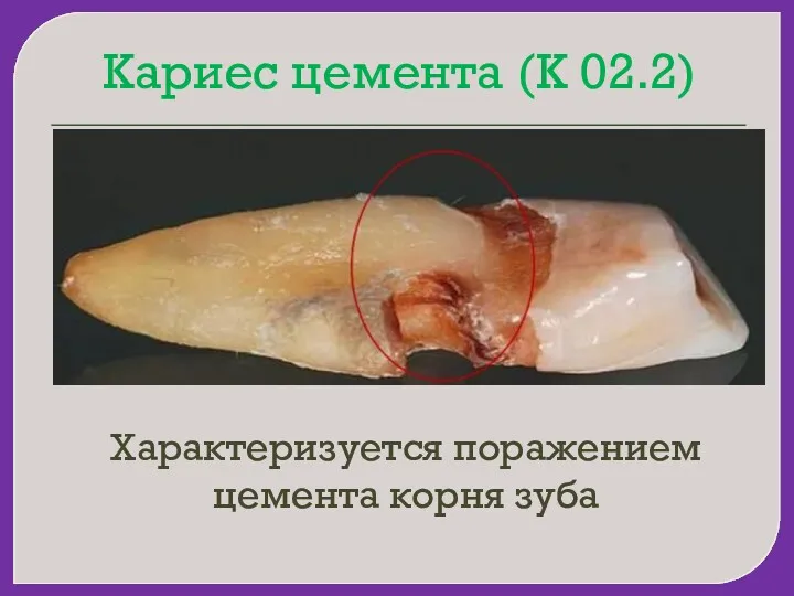 Кариес цемента (К 02.2) Характеризуется поражением цемента корня зуба