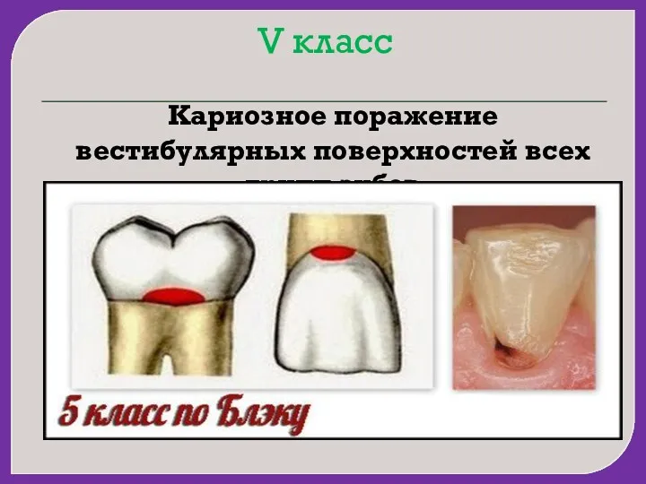 V класс Кариозное поражение вестибулярных поверхностей всех групп зубов