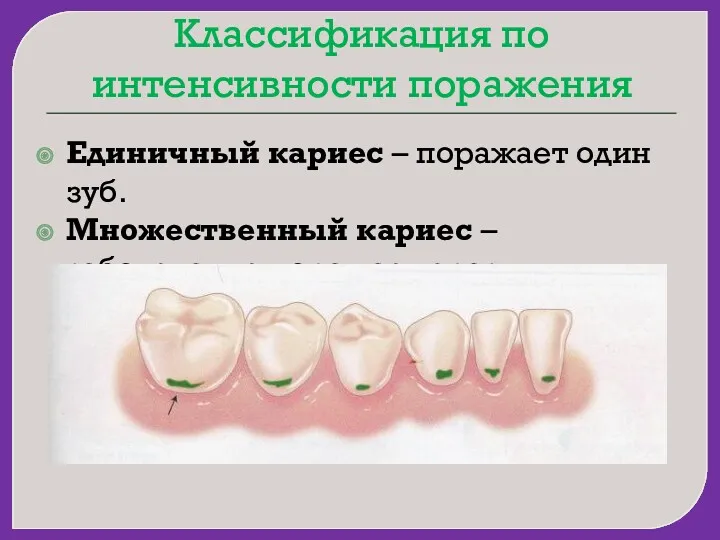 Классификация по интенсивности поражения Единичный кариес – поражает один зуб.