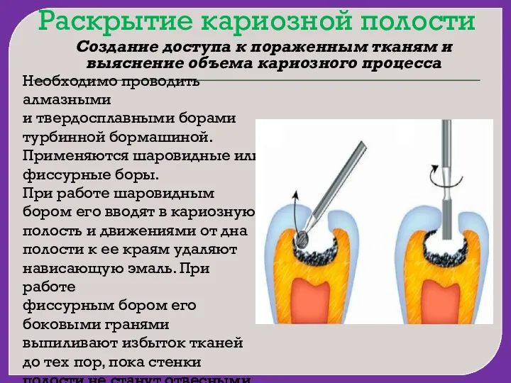 Раскрытие кариозной полости Создание доступа к пораженным тканям и выяснение