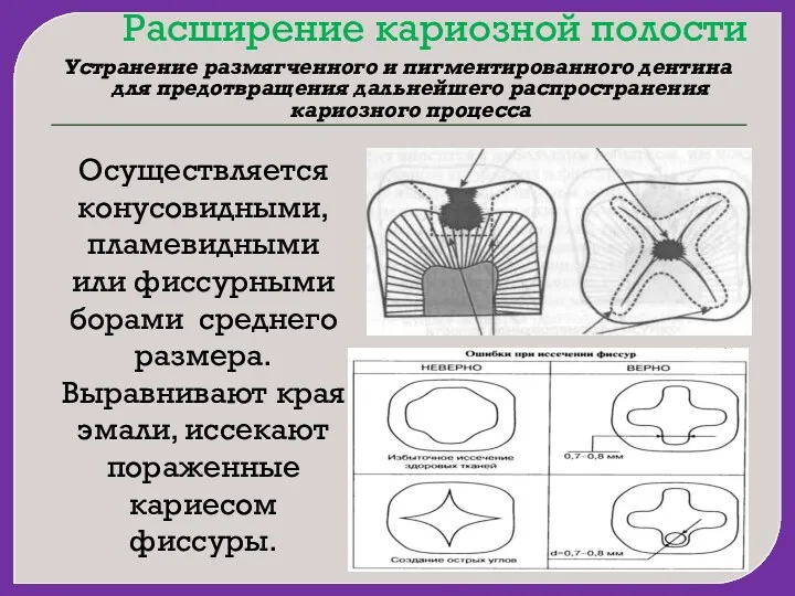 Расширение кариозной полости Устранение размягченного и пигментированного дентина для предотвращения