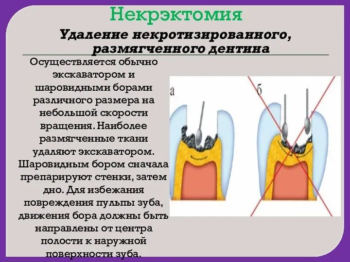 Некрэктомия Удаление некротизированного, размягченного дентина Осуществляется обычно экскаватором и шаровидными