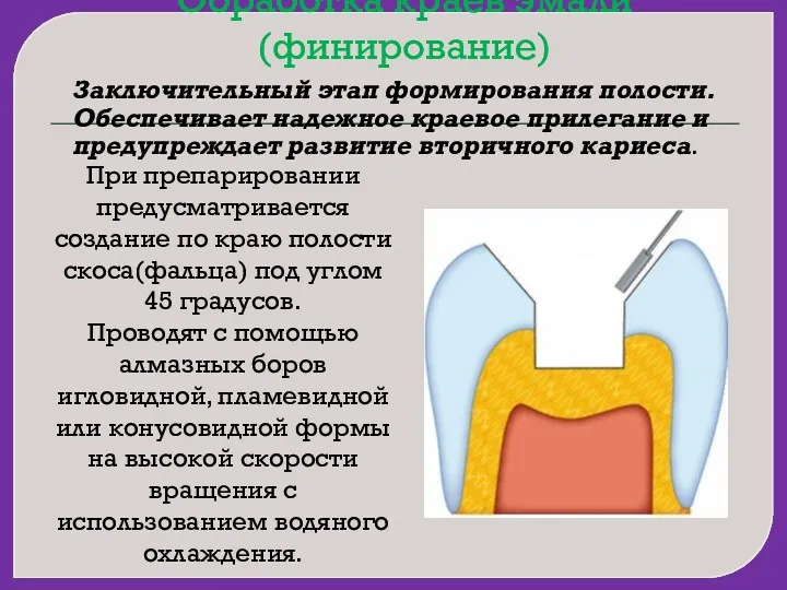 Обработка краев эмали(финирование) Заключительный этап формирования полости. Обеспечивает надежное краевое