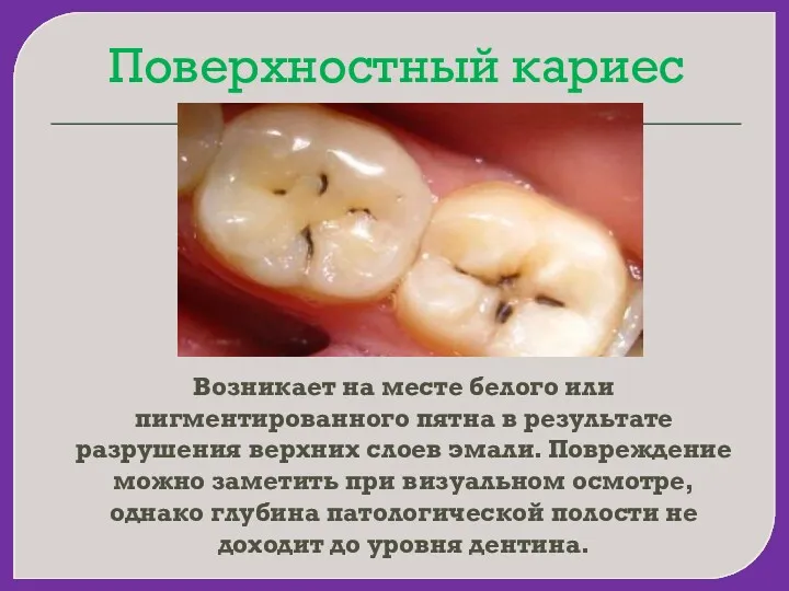 Поверхностный кариес Возникает на месте белого или пигментированного пятна в