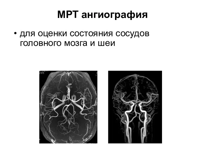 МРТ ангиография для оценки состояния сосудов головного мозга и шеи