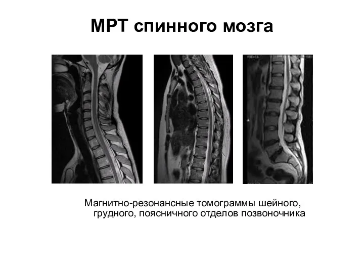 МРТ спинного мозга Магнитно-резонансные томограммы шейного, грудного, поясничного отделов позвоночника
