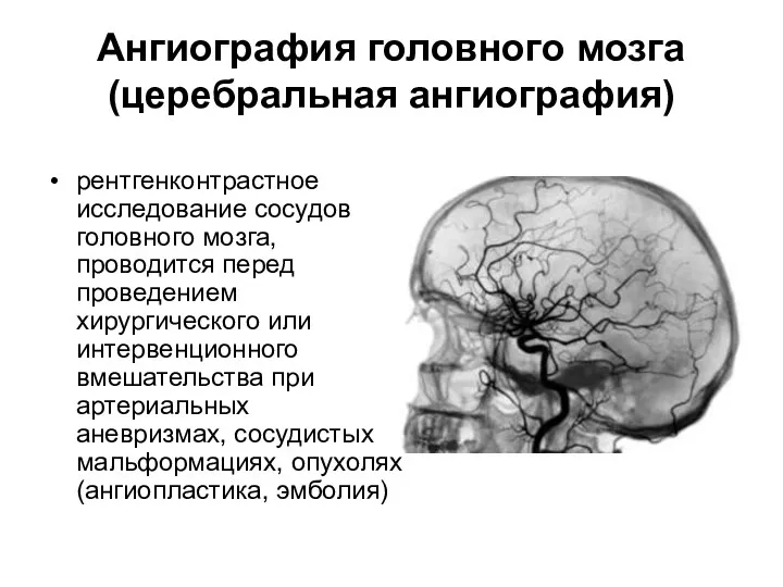 Ангиография головного мозга (церебральная ангиография) рентгенконтрастное исследование сосудов головного мозга, проводится перед проведением