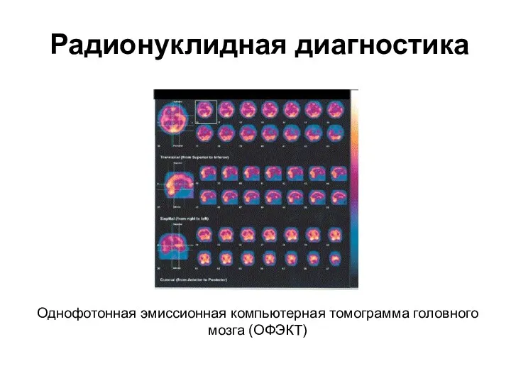 Радионуклидная диагностика Однофотонная эмиссионная компьютерная томограмма головного мозга (ОФЭКТ)