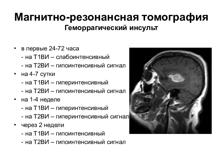 Магнитно-резонансная томография Геморрагический инсульт в первые 24-72 часа - на Т1ВИ – слабоинтенсивный