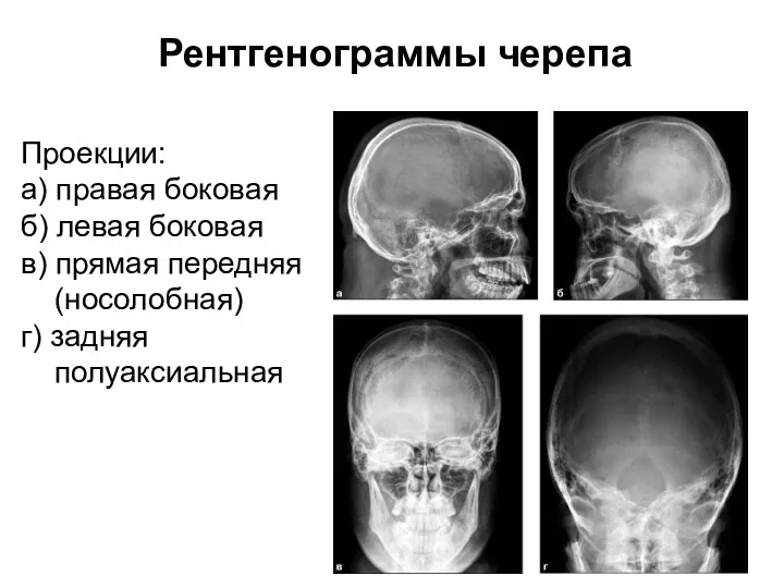 Рентгенограммы черепа Проекции: а) правая боковая б) левая боковая в) прямая передняя (носолобная) г) задняя полуаксиальная
