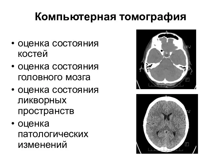 Компьютерная томография оценка состояния костей оценка состояния головного мозга оценка состояния ликворных пространств оценка патологических изменений