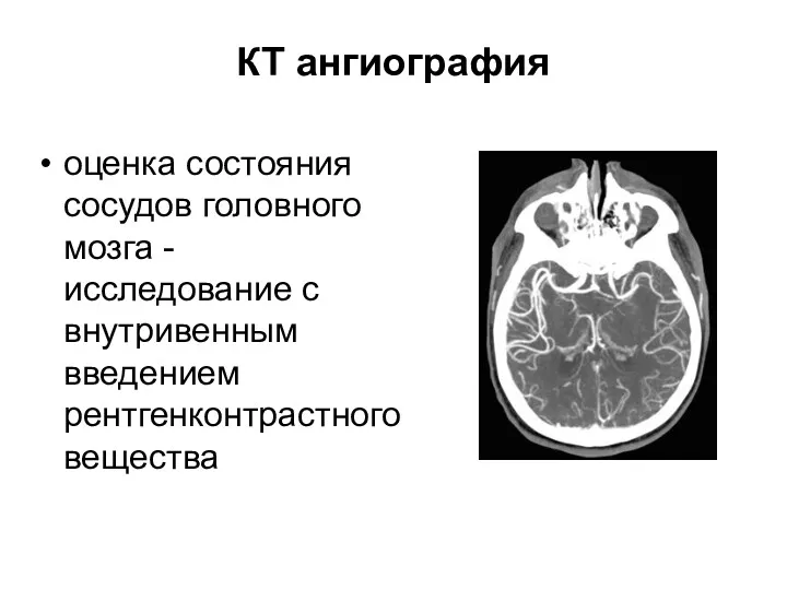 КТ ангиография оценка состояния сосудов головного мозга - исследование с внутривенным введением рентгенконтрастного вещества