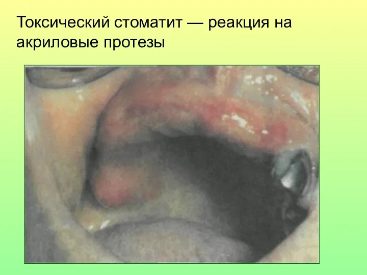 Токсический стоматит — реакция на акриловые протезы