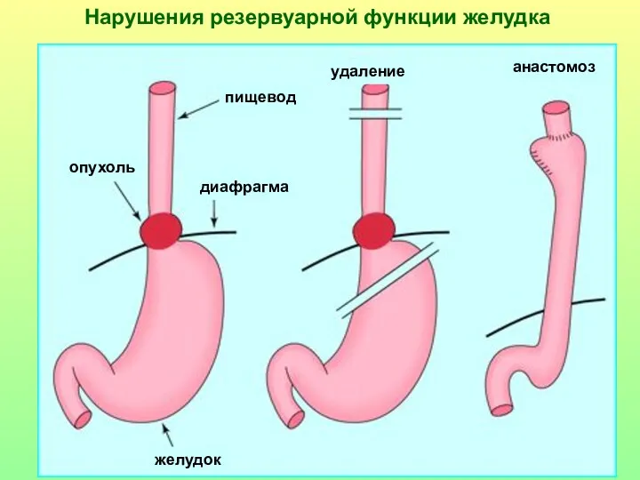 желудок опухоль диафрагма пищевод анастомоз удаление Нарушения резервуарной функции желудка