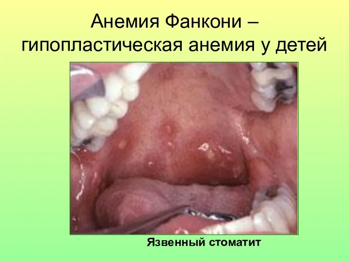 Анемия Фанкони – гипопластическая анемия у детей Язвенный стоматит