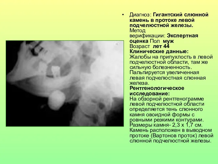 Диагноз: Гигантский слюнной камень в протоке левой подчелюстной железы. Метод