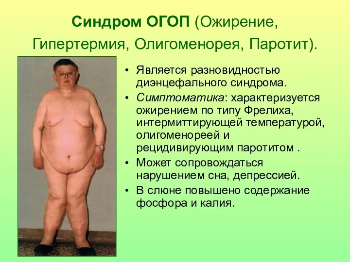Синдром ОГОП (Ожирение, Гипертермия, Олигоменорея, Паротит). Является разновидностью диэнцефального синдрома.