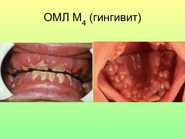 ОМЛ М4 (гингивит)