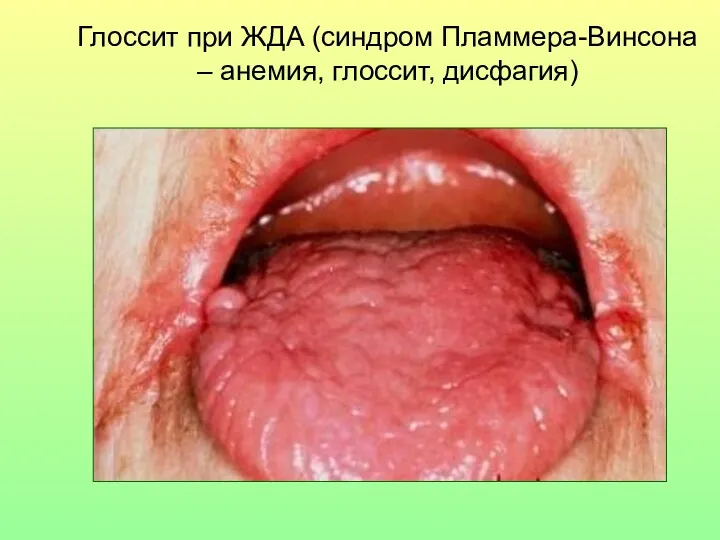Глоссит при ЖДА (синдром Пламмера-Винсона – анемия, глоссит, дисфагия)