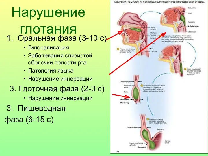 Нарушение глотания 1. Оральная фаза (3-10 с) Гипосаливация Заболевания слизистой