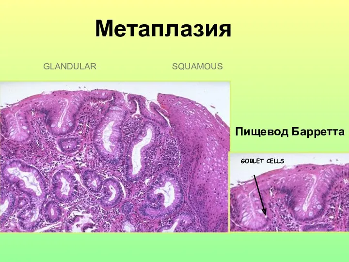 Метаплазия SQUAMOUS Пищевод Барретта GLANDULAR GOBLET CELLS